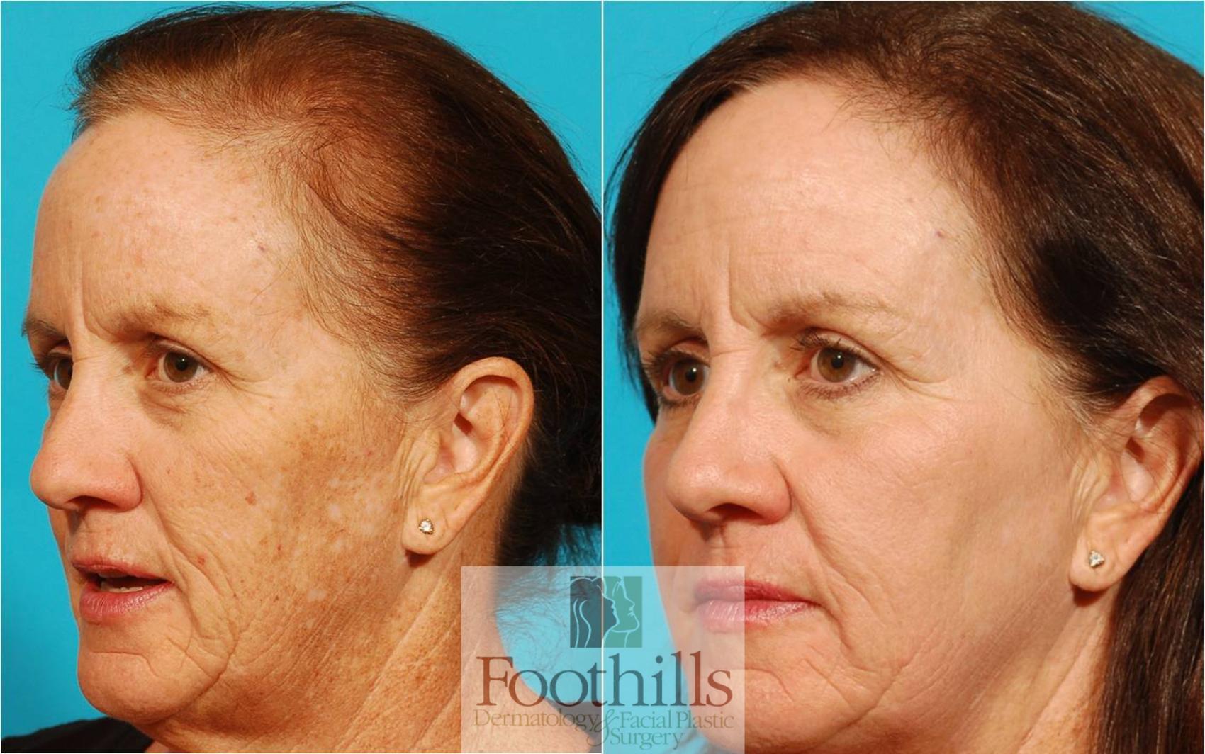 IPL Photofacial Case 38 Before & After View #1 | Tucson, AZ | Foothills Facial Plastic Surgery
