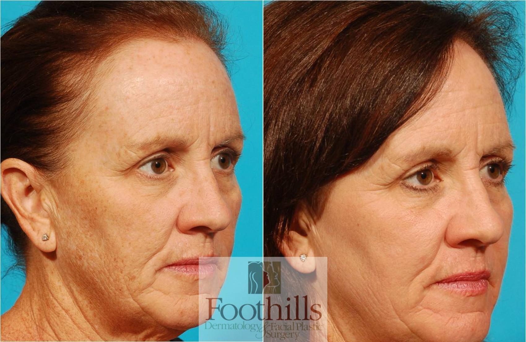 Foothills Dermatology & Facial Plastic Surgery IPL Photofacial Before & After Photos Patient 38 | Tucson, AZ
