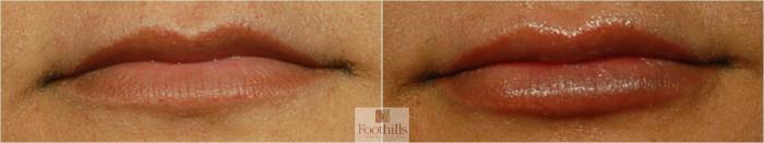 Lip Filler Case 68 Before & After View #1 | Tucson, AZ | Foothills Facial Plastic Surgery