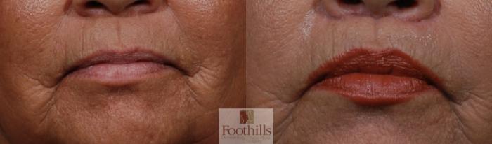 Lip Lift Case 118 Before & After View #1 | Tucson, AZ | Foothills Facial Plastic Surgery