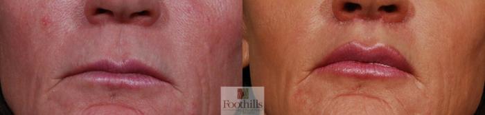 Lip Lift Case 124 Before & After View #1 | Tucson, AZ | Foothills Facial Plastic Surgery