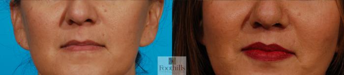 Lip Lift Case 132 Before & After View #1 | Tucson, AZ | Foothills Facial Plastic Surgery