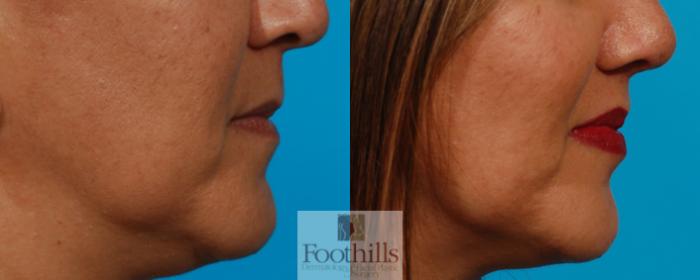 Lip Lift Case 132 Before & After View #2 | Tucson, AZ | Foothills Facial Plastic Surgery