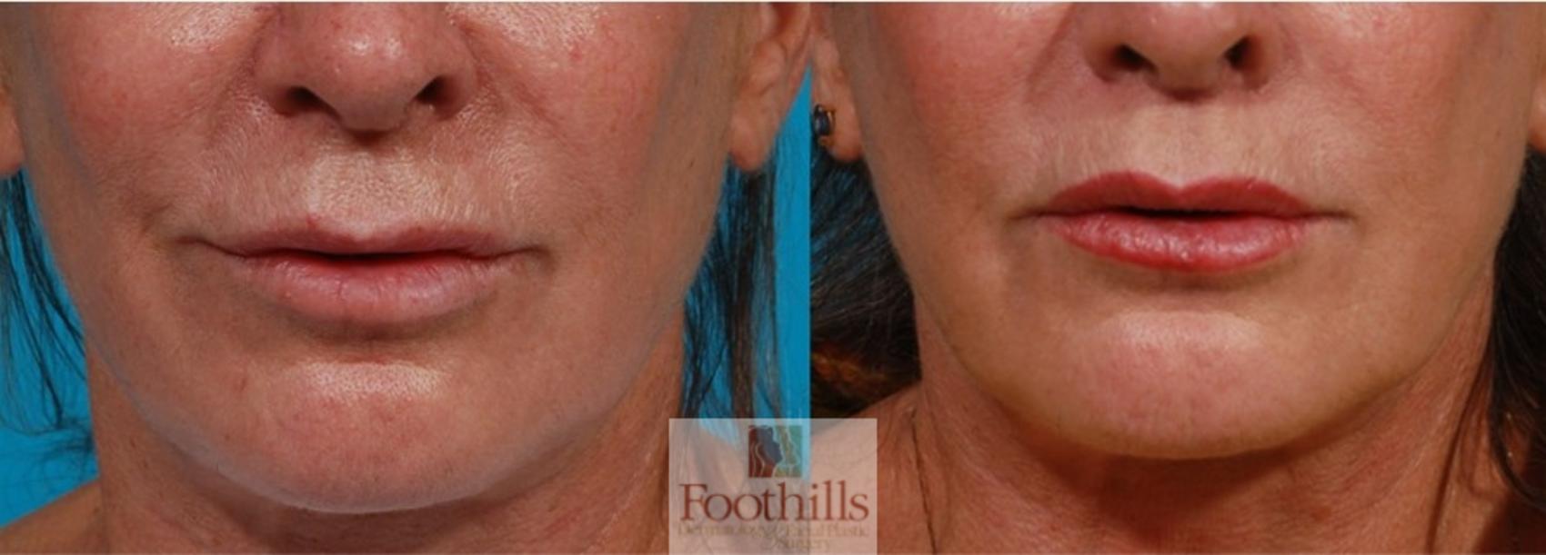 Lip Lift Case 141 Before & After Front | Tucson, AZ | Foothills Facial Plastic Surgery