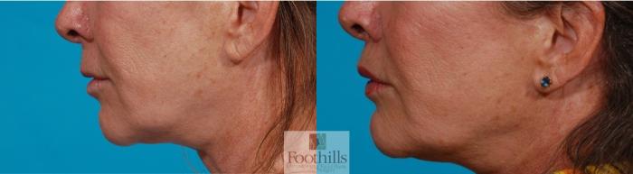 Lip Lift Case 141 Before & After Left Side | Tucson, AZ | Foothills Facial Plastic Surgery
