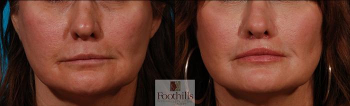 Lip Lift Case 144 Before & After Front | Tucson, AZ | Foothills Facial Plastic Surgery