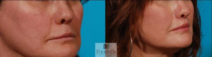 Lip Lift Case 144 Before & After Right Oblique | Tucson, AZ | Foothills Facial Plastic Surgery