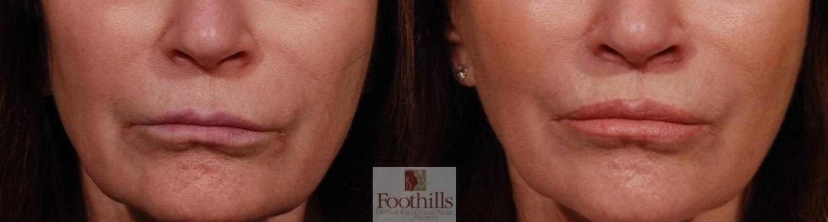 Lip Lift Case 161 Before & After Front | Tucson, AZ | Foothills Facial Plastic Surgery