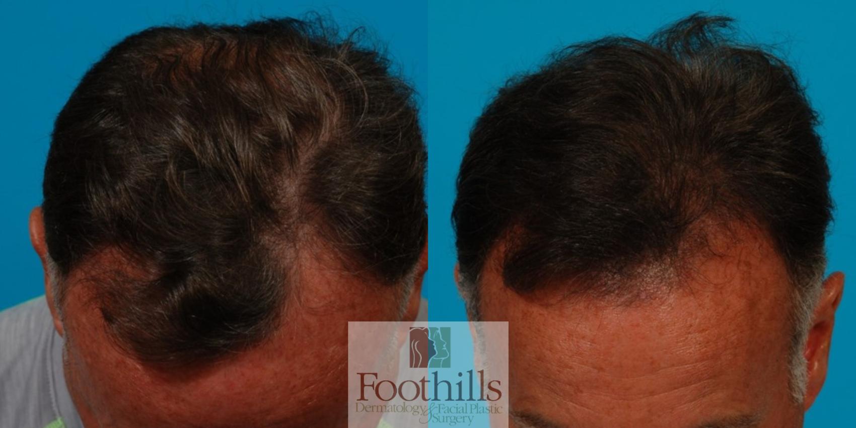 NeoGraft® Case 108 Before & After View #1 | Tucson, AZ | Foothills Facial Plastic Surgery