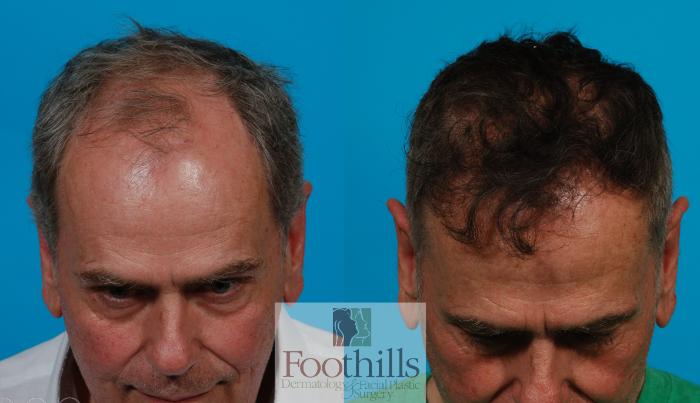 NeoGraft® Case 129 Before & After View #1 | Tucson, AZ | Foothills Facial Plastic Surgery