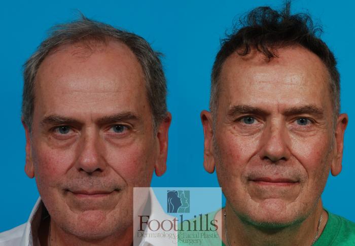 NeoGraft® Case 129 Before & After View #2 | Tucson, AZ | Foothills Facial Plastic Surgery