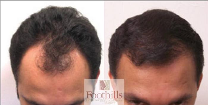 NeoGraft® Case 85 Before & After View #1 | Tucson, AZ | Foothills Facial Plastic Surgery