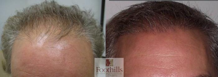 NeoGraft® Case 86 Before & After View #1 | Tucson, AZ | Foothills Facial Plastic Surgery