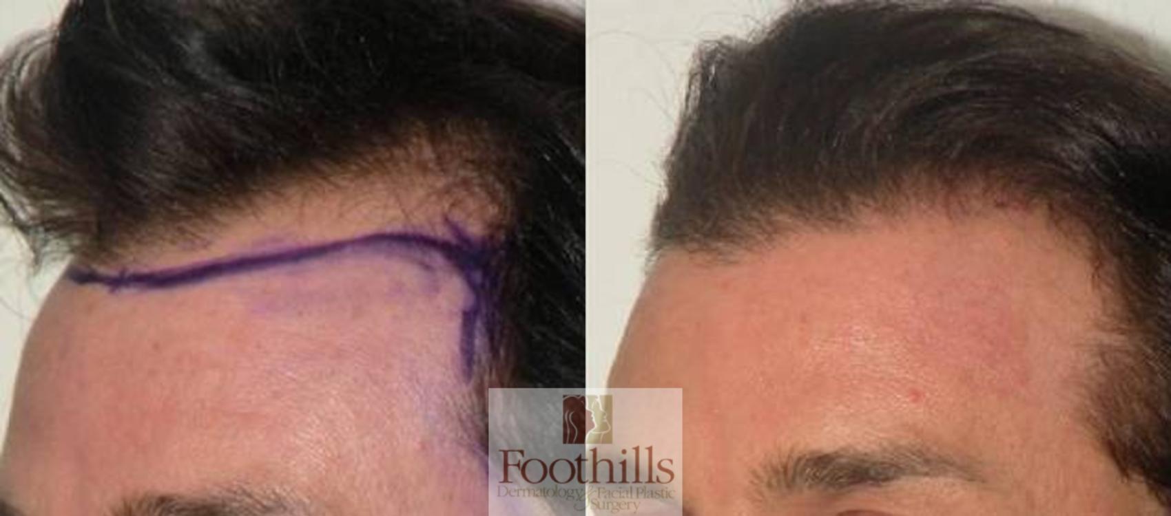 NeoGraft® Case 87 Before & After View #1 | Tucson, AZ | Foothills Facial Plastic Surgery