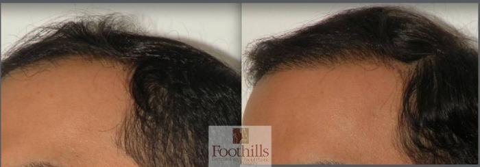 NeoGraft® Case 88 Before & After View #1 | Tucson, AZ | Foothills Facial Plastic Surgery