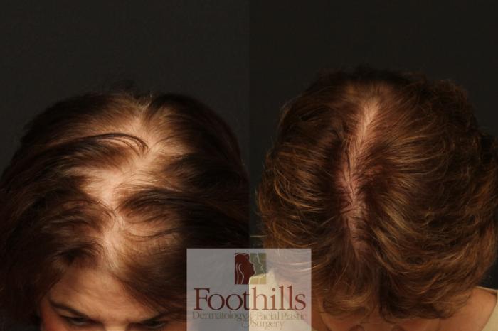 NeoGraft® Case 91 Before & After View #1 | Tucson, AZ | Foothills Facial Plastic Surgery