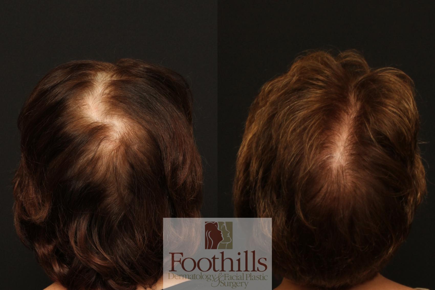NeoGraft® Case 92 Before & After View #1 | Tucson, AZ | Foothills Facial Plastic Surgery