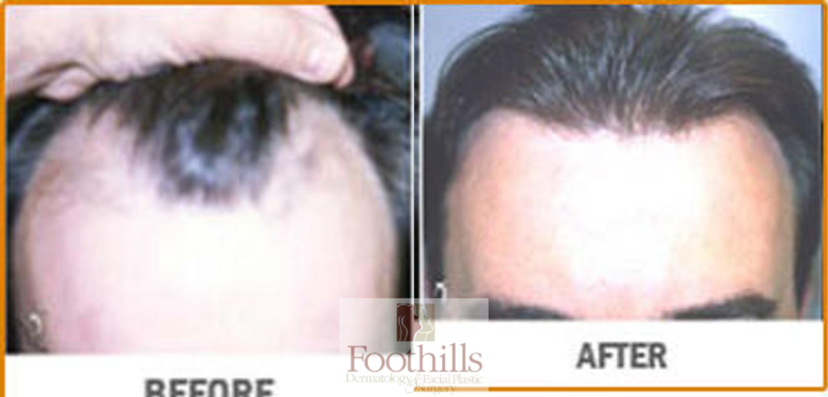 NeoGraft® Case 93 Before & After View #1 | Tucson, AZ | Foothills Facial Plastic Surgery