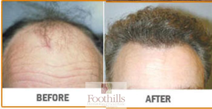 NeoGraft® Case 94 Before & After View #1 | Tucson, AZ | Foothills Facial Plastic Surgery