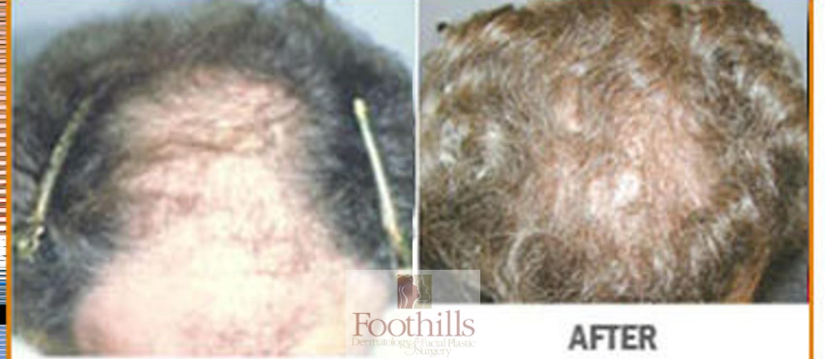 NeoGraft® Case 96 Before & After View #1 | Tucson, AZ | Foothills Facial Plastic Surgery