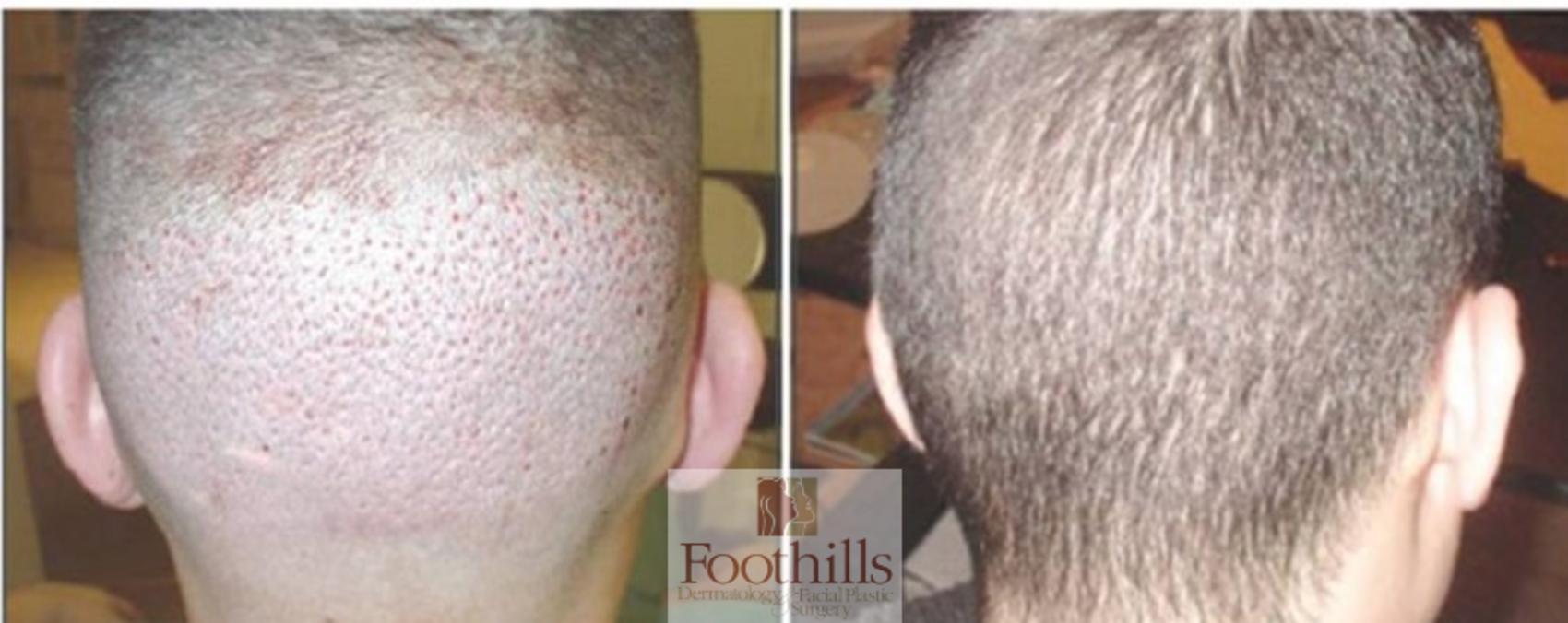 NeoGraft® Case 97 Before & After View #1 | Tucson, AZ | Foothills Facial Plastic Surgery