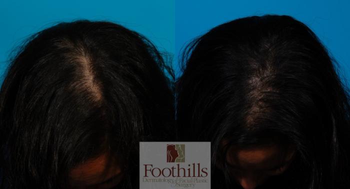 PRP Hair Restoration Case 105 Before & After View #1 | Tucson, AZ | Foothills Facial Plastic Surgery