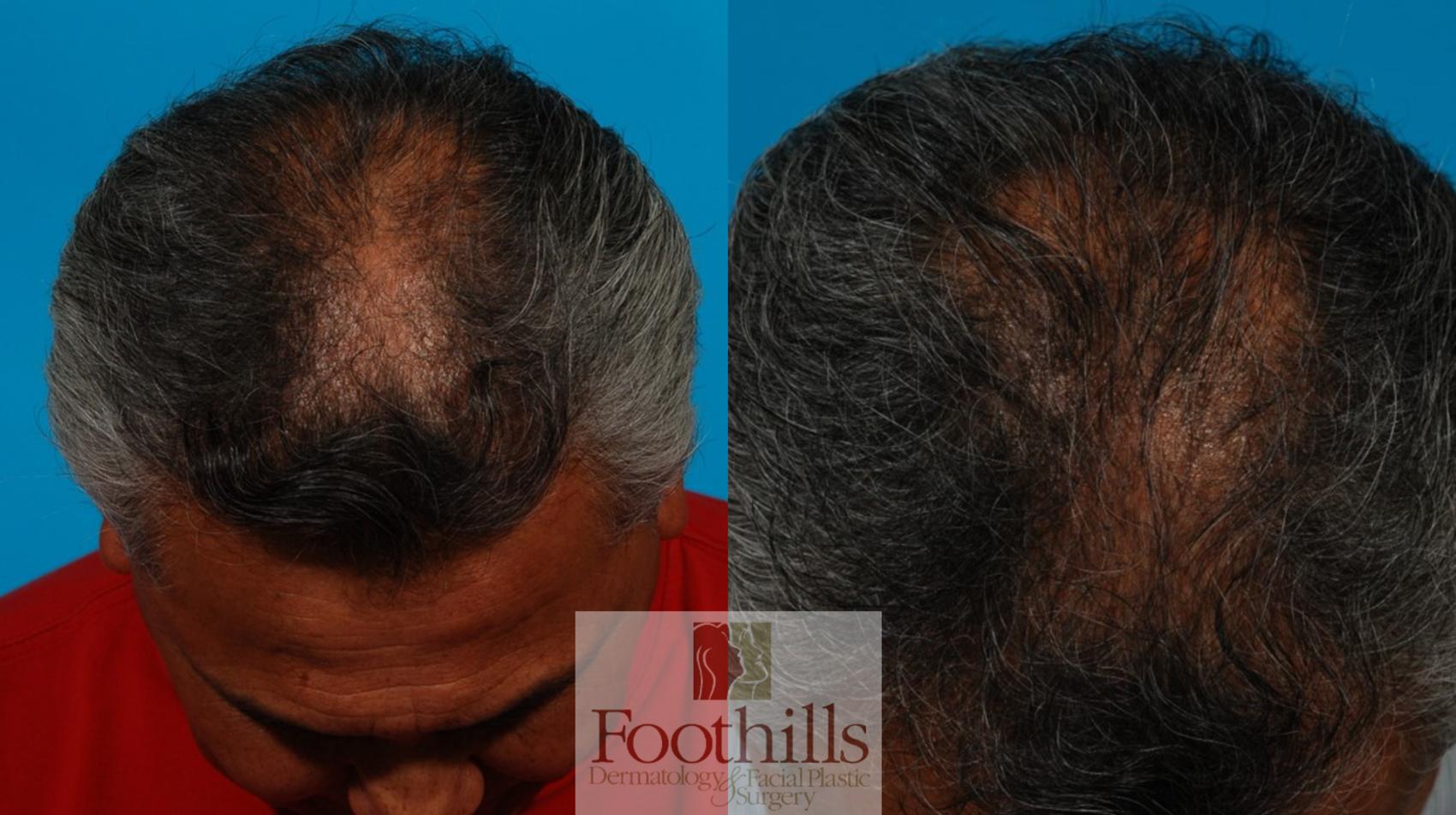 PRP Hair Restoration Case 106 Before & After View #1 | Tucson, AZ | Foothills Facial Plastic Surgery