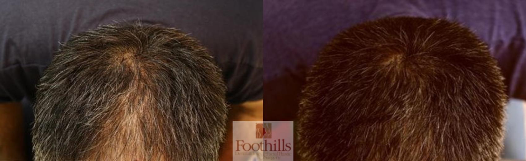 PRP Hair Restoration Case 125 Before & After View #1 | Tucson, AZ | Foothills Facial Plastic Surgery