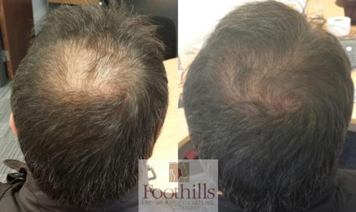 PRP Hair Restoration Case 126 Before & After View #1 | Tucson, AZ | Foothills Facial Plastic Surgery