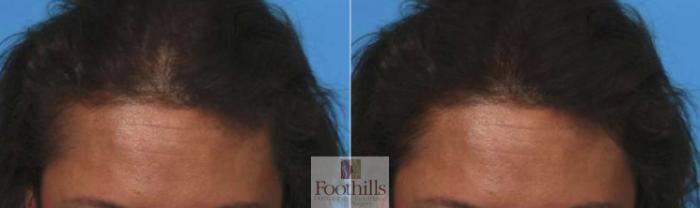 PRP Hair Restoration Case 127 Before & After View #1 | Tucson, AZ | Foothills Facial Plastic Surgery