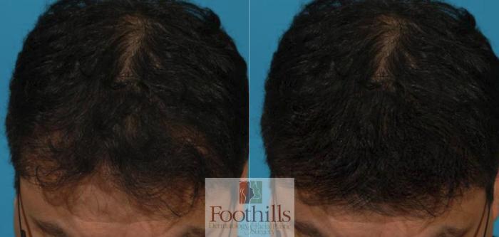 PRP Hair Restoration Case 128 Before & After View #1 | Tucson, AZ | Foothills Facial Plastic Surgery