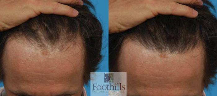 PRP Hair Restoration Case 138 Before & After View #1 | Tucson, AZ | Foothills Facial Plastic Surgery