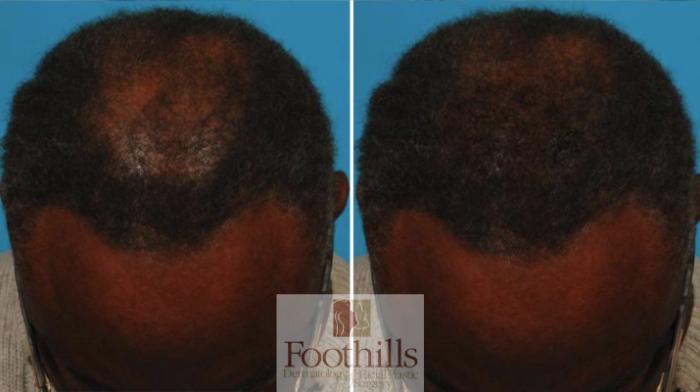 PRP Hair Restoration Case 139 Before & After View #1 | Tucson, AZ | Foothills Facial Plastic Surgery