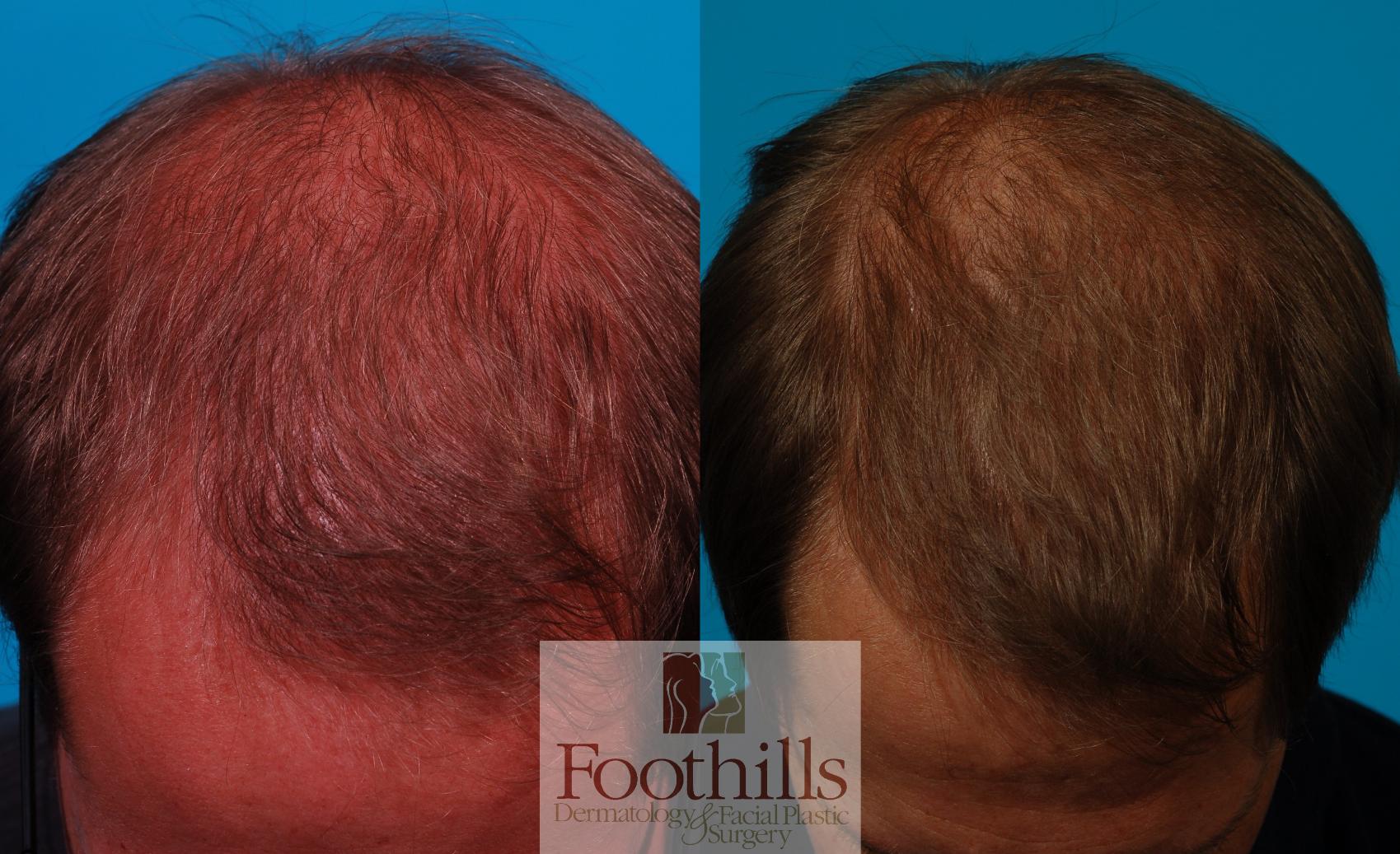 PRP Hair Restoration Case 160 Before & After Front | Tucson, AZ | Foothills Facial Plastic Surgery