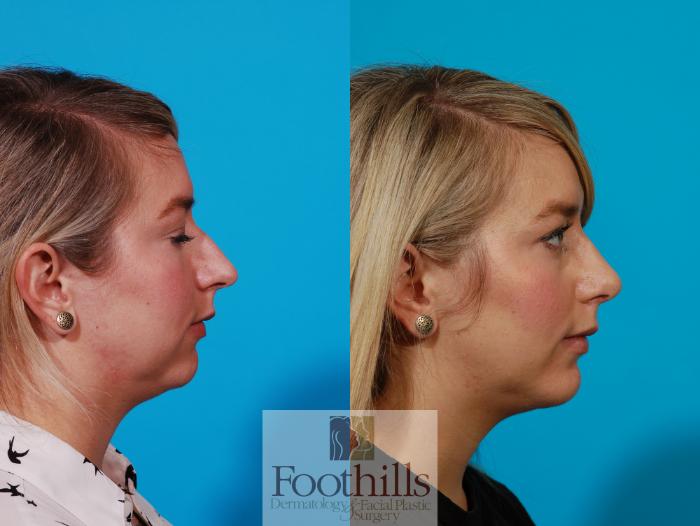 Rhinoplasty Case 102 Before & After View #1 | Tucson, AZ | Foothills Facial Plastic Surgery