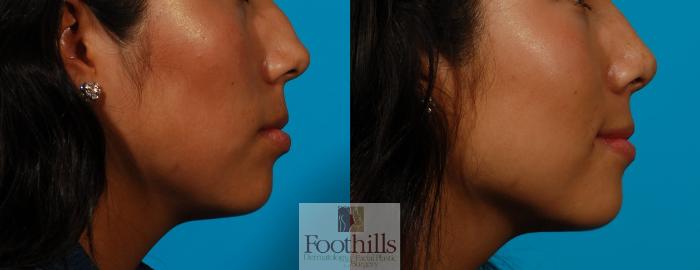 Rhinoplasty Case 109 Before & After View #1 | Tucson, AZ | Foothills Facial Plastic Surgery