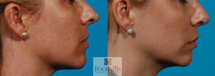 Rhinoplasty Case 110 Before & After View #1 | Tucson, AZ | Foothills Facial Plastic Surgery