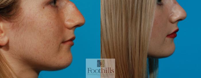Rhinoplasty Case 111 Before & After View #1 | Tucson, AZ | Foothills Facial Plastic Surgery