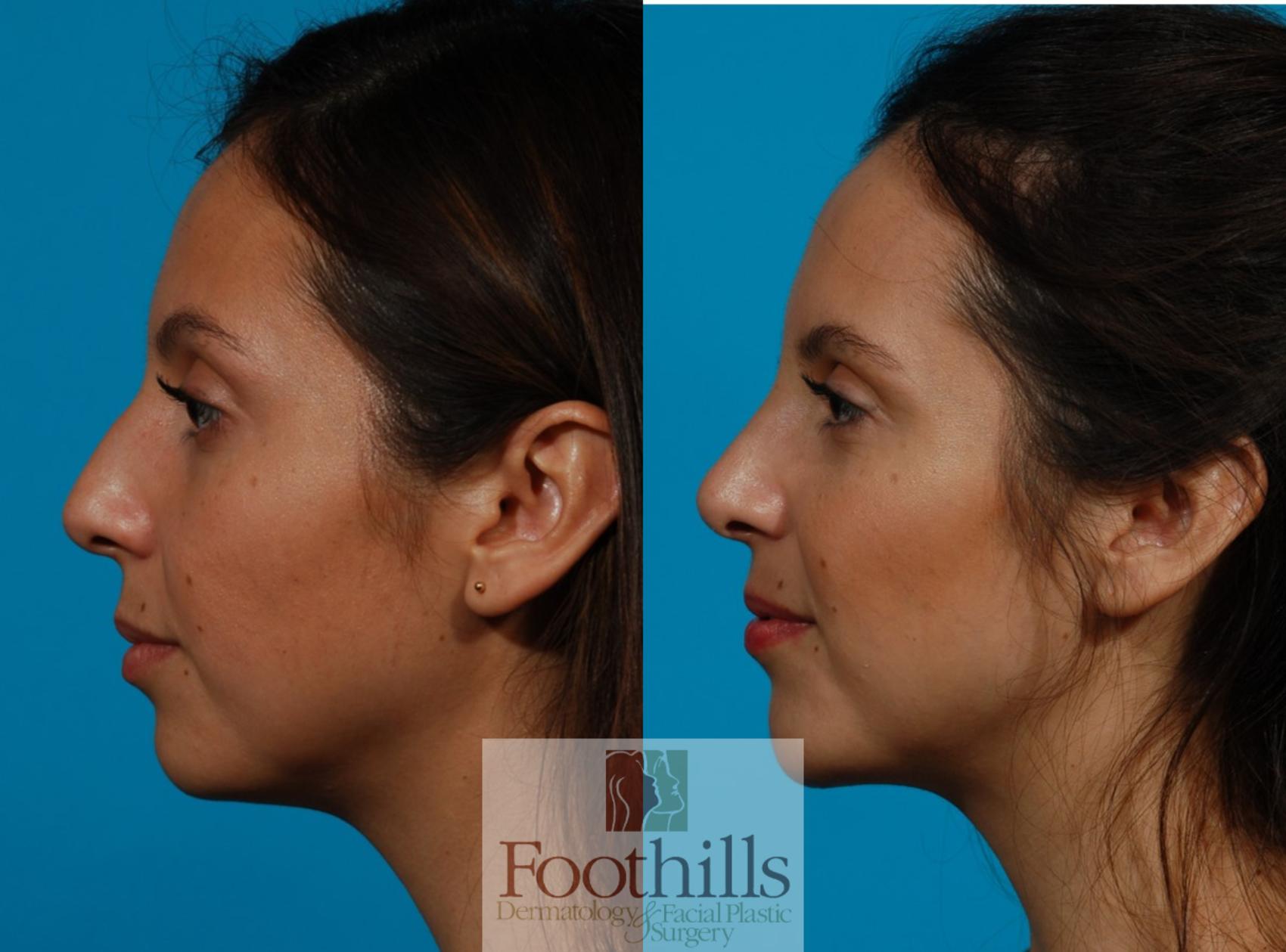 Rhinoplasty Case 121 Before & After View #1 | Tucson, AZ | Foothills Facial Plastic Surgery
