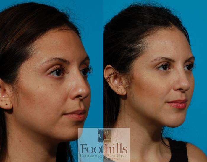 Rhinoplasty Case 121 Before & After View #2 | Tucson, AZ | Foothills Facial Plastic Surgery