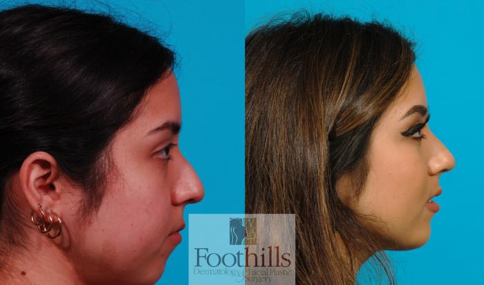 Rhinoplasty Case 130 Before & After View #1 | Tucson, AZ | Foothills Facial Plastic Surgery
