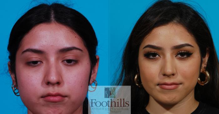 Rhinoplasty Case 130 Before & After View #2 | Tucson, AZ | Foothills Facial Plastic Surgery