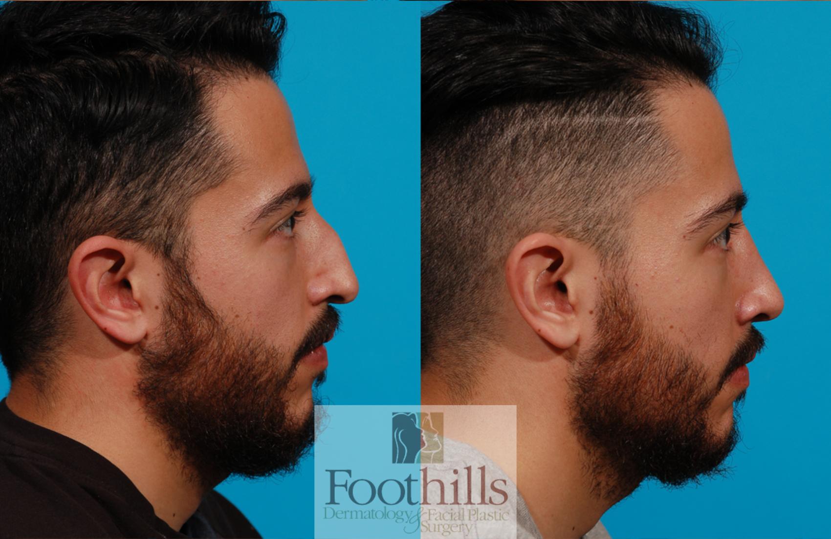 Rhinoplasty Case 135 Before & After View #1 | Tucson, AZ | Foothills Facial Plastic Surgery