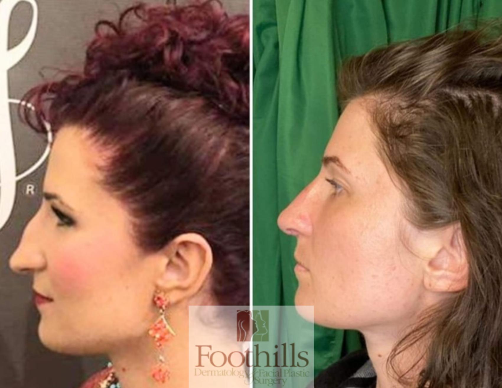 Rhinoplasty Case 136 Before & After View #1 | Tucson, AZ | Foothills Facial Plastic Surgery