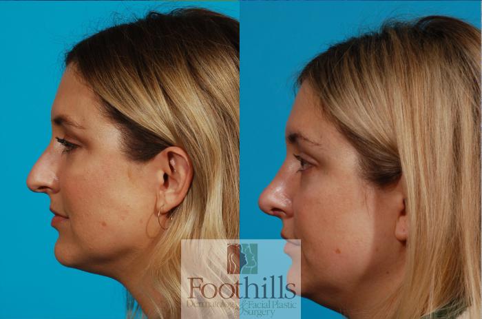Rhinoplasty Case 137 Before & After View #1 | Tucson, AZ | Foothills Facial Plastic Surgery