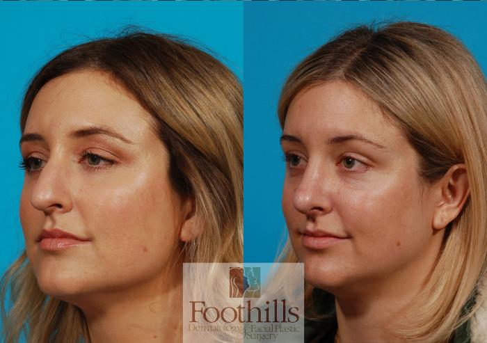 Rhinoplasty Case 137 Before & After View #2 | Tucson, AZ | Foothills Facial Plastic Surgery