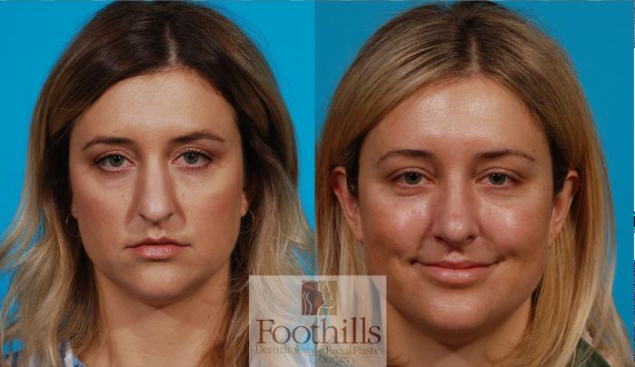 Rhinoplasty Case 137 Before & After View #3 | Tucson, AZ | Foothills Facial Plastic Surgery