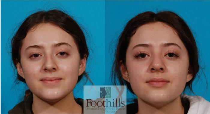 Rhinoplasty Case 142 Before & After Front | Tucson, AZ | Foothills Facial Plastic Surgery