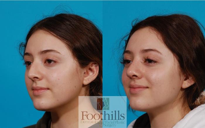 Rhinoplasty Case 142 Before & After Left Oblique | Tucson, AZ | Foothills Facial Plastic Surgery