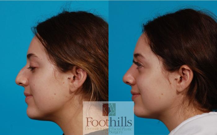 Rhinoplasty Case 142 Before & After Left Side | Tucson, AZ | Foothills Facial Plastic Surgery